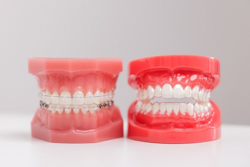 Dental models showing different tooth and bite alignments, including braces and misaligned teeth.