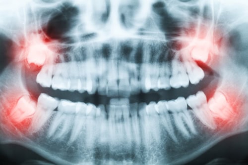 Dentist showing a patient a panoramic dental X-ray and explaining an area of concern in the jaw.