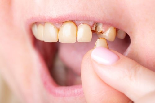 Close-up of a person holding a broken tooth beside a damaged gap in their upper teeth.